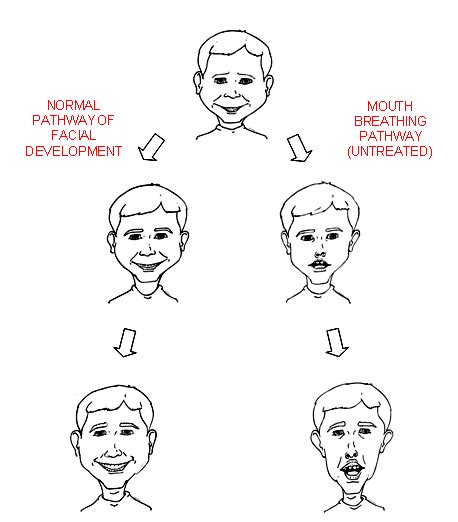 Avoid drinking alcohol close to. Mouth breathing is NOT normal. Have your child assessed ...