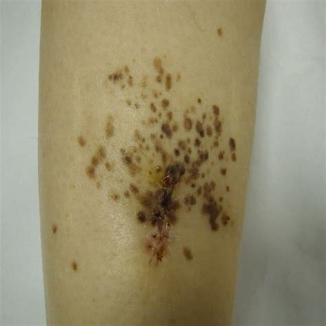 Speckled Lentiginous Nevus On The Inferior Part Of The Leg After