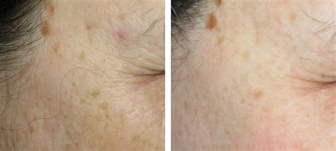 Ipl Therapy Before And After Kingsway Dermatology