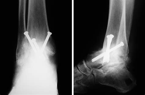 What To Know About Ankle Fusion Surgery Health