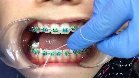 how to floss with braces easy how to floss with braces methods tips and more you can use it