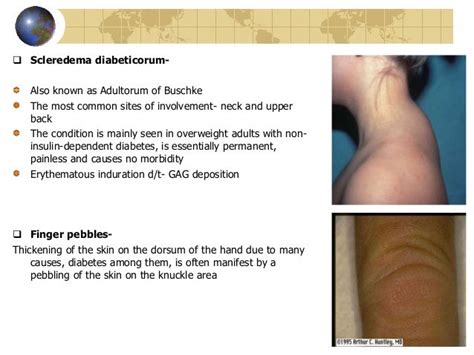 Cutaneous Manifeatations In Endocrine Disorders
