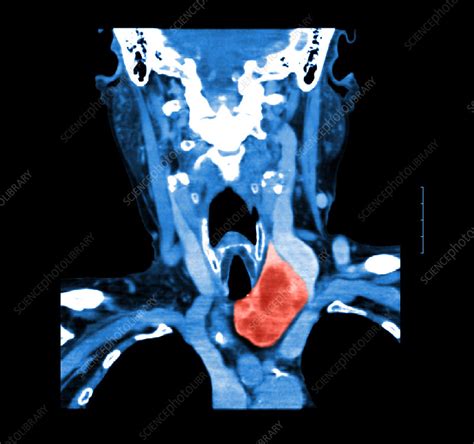 Ct Of Neck Showing Thyroid Goiter Stock Image F0312775 Science