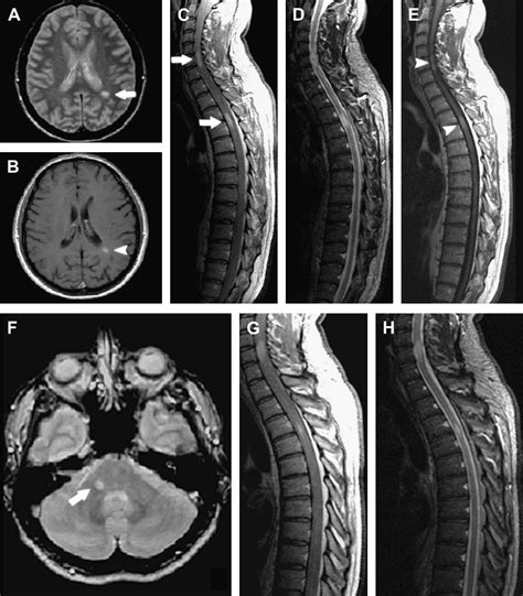 Spinal Cord Mri In Multiple Sclerosis Conventional And Nonconventional