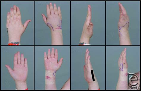 Unilateral Swollen Hand A Rare Case Of Primary Lymphedema Tarda