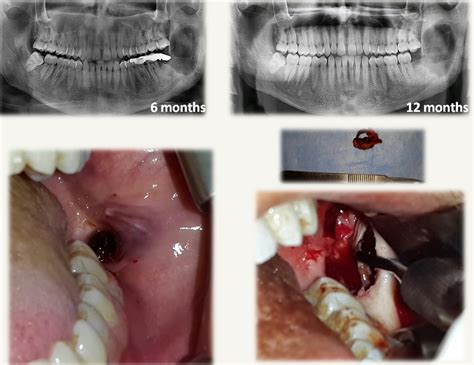 Maxillary Sinus Polyps Cysts