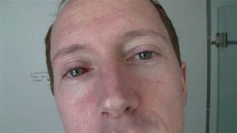 Updated Subconjunctival Hemorrhage Burst Blood Vessel In My Eye