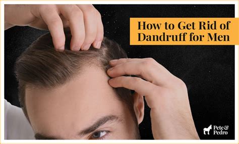 How To Get Rid Of Dandruff For Men Causes Treatments Tips