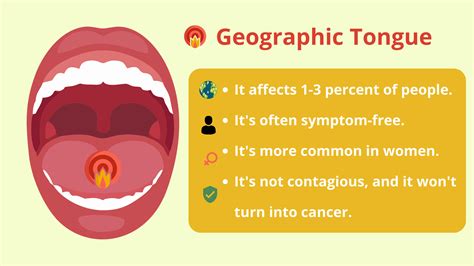 Geographic Tongue A Common Yet Mysterious Oral Condition