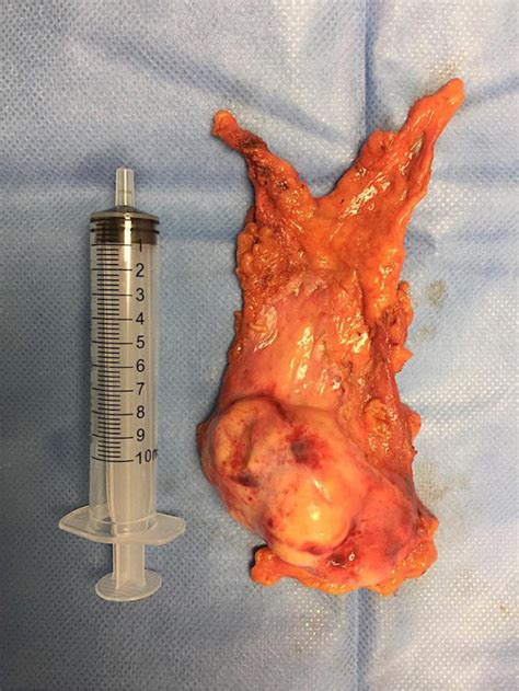 Gross Specimen After En Bloc Video Assisted Thoracic Surgery Thymectomy