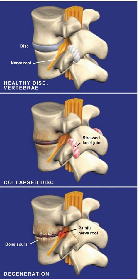 Spondylosis Stephen P Courtney Md Orthopedic Spine Surgeon Plano Tx Advanced Spine Center
