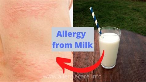 Allergy From Milk Symptom To Cure And More Allergie Care
