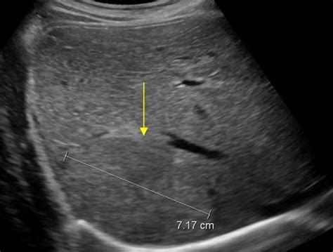 Focal Nodular Hyperplasia Liver Ultrasound