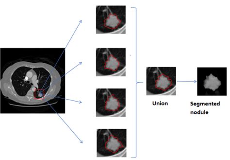 Lung Nodule Extraction Procedure Download Scientific Diagram