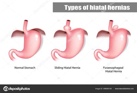 Hiatal Hiatal Hernia And Normal Anatomy Of The Stomach Stock Vector By