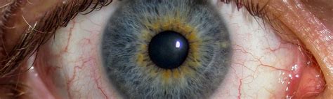 Diagnosis and treatment of uveitis. Qué es la uveítis