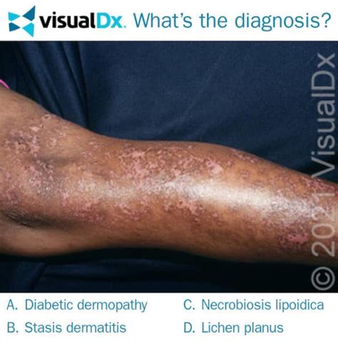 Woman With Diabetes Has Atrophic Scars On Shins Lets Diagnose
