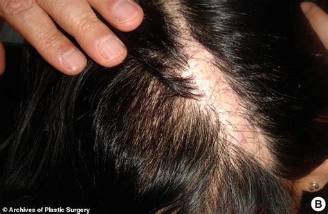 Shocking Image Shows 21 Year Old Whose Scalp Was Scalded Off After