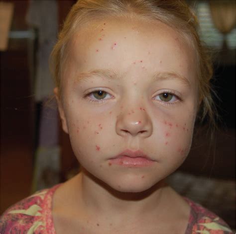 Papular Rash In A Child After A Fever Aafp