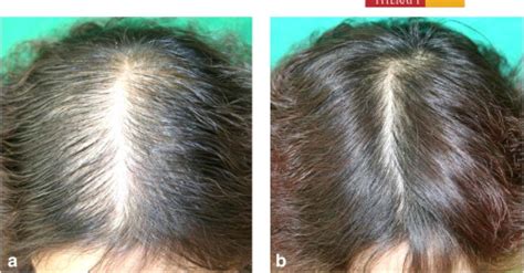 Finasteride Mg Hair Loss