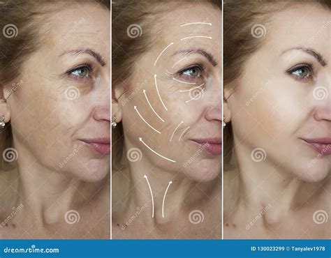 Woman Face Wrinkles Removal Dermatology Before And After Difference