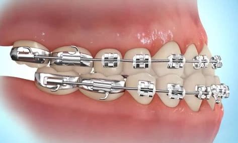 So last week i got rubber bands on my braces from the top back teeth to the bottom and i have a few quesitons if you please help me, many thanks <3 :) 1. How to Put Rubber Bands On Braces | Premier Orthodontics