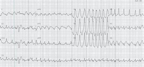 Ecg Case Litfl Ecg Top Self Assessment Quiz Medication Management Pr Interval