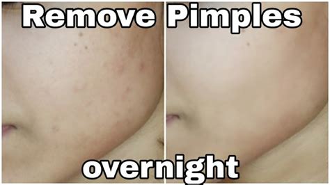 How To Remove Pimples Acne Pimple Marks Completely Live Result