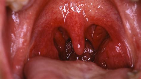 Learn more about how to get rid of hiccups, since they're kind of a mystery and also annoying as hell. What Causes the Hiccups? - NBC News