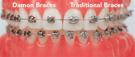 How to get braces for free or an affordable price. Orthodontics Damon Braces and Lingual Braces Bromley