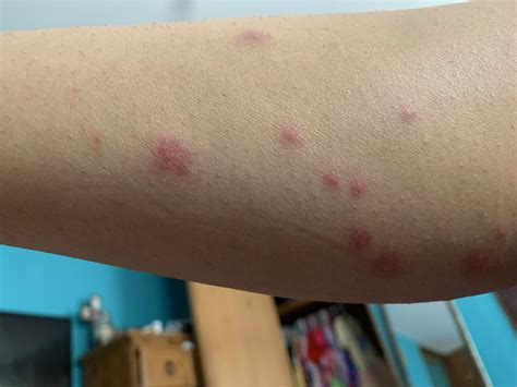 Bed Bug Bites Pictures Symptoms What Do Bed Bug Bites Look Like