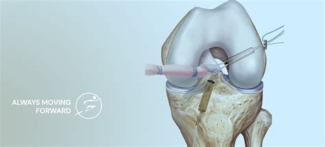 Acl Reconstruction Surgery Acl Surgery Dr Vinay Tantuway