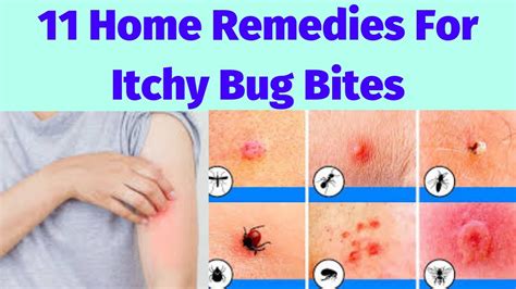 11 Home Remedies For Itchy Bug Bites Youtube