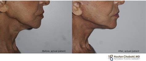 You Are Not A Candidate For Kybella Nonsurgical Neck Fat Reduction