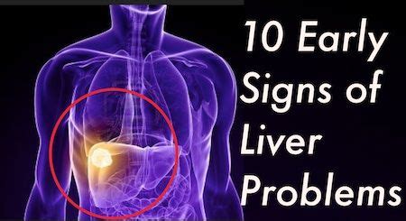 10 Early Signs of Liver Problems You Should Never Ignore | Signs of liver problems, Health ...