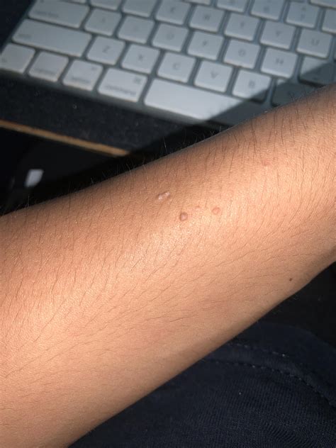 No Matter How Much I Peel At These Small Bumps On My Arm They Never Go