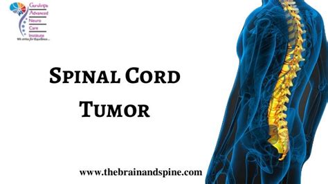 Spinal Cord Tumor Treatment In New Delhi Treatment For Spinal Canc