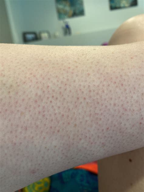 Skin Concerns My Legs Make The Red Bumps Stop Anyone R