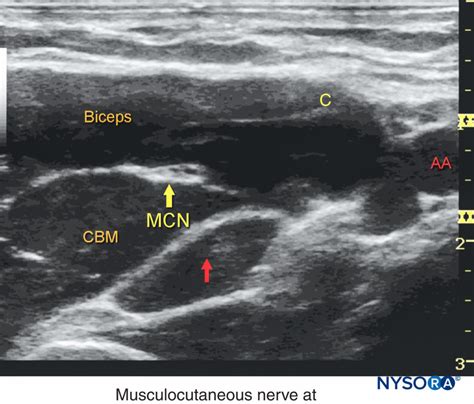 Ultrasound Guided Axillary Brachial Plexus Block Nysora Nysora