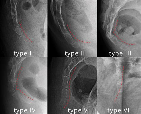 Imaging Coccygeal Trauma And Coccydynia Radiographics