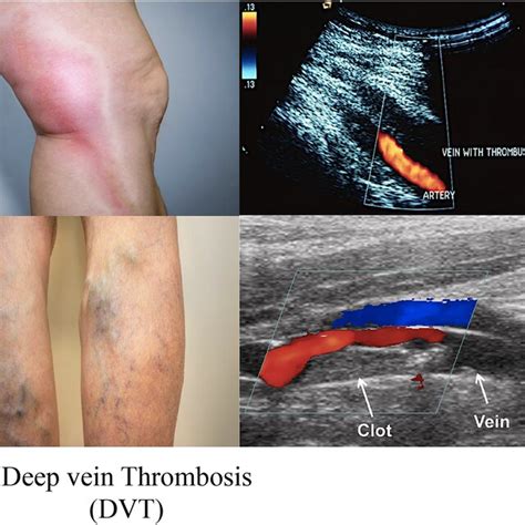 A D Clinical Condition Of Deep Vein Thrombosis A A Poor Blood Flow