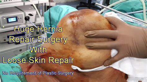 Huge Hernia Repair Surgery Hybrid Hernioplasty By Dr Sumeet Shah