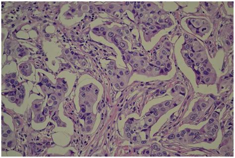 Clinicopathological Features Of Invasive Micropapillary Carcinoma Of