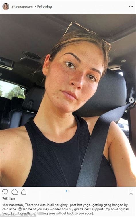 Shauna Sexton Complains Of Being Gang Banged By Chin Acne After Yoga