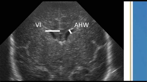 Ventricular Measurements On Neonatal Head Ultrasound Youtube