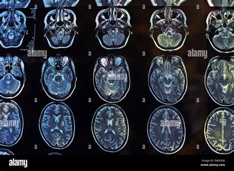 Magnetic Resonance Image Scan Of The Brain Mri Film Of A Human Skull