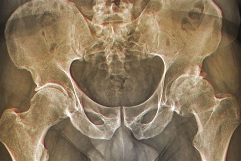 Overview Of Hip Osteoarthritis