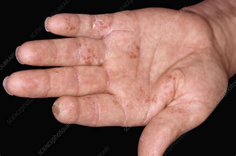 Pompholyx Blisters On The Hand Stock Image C0509842 Science