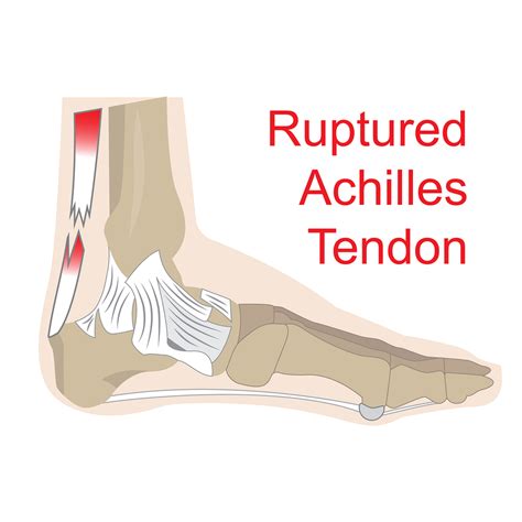 Process flow diagram visio template. How Runners Heal Achilles Tendinitis Without a Doctor and ...