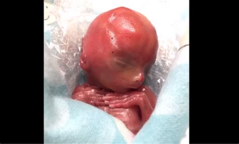 Amazing Video Of Jaxon Miscarried At 18 Weeks Shows